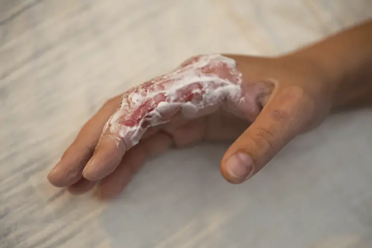 burn-injury-lawsuit